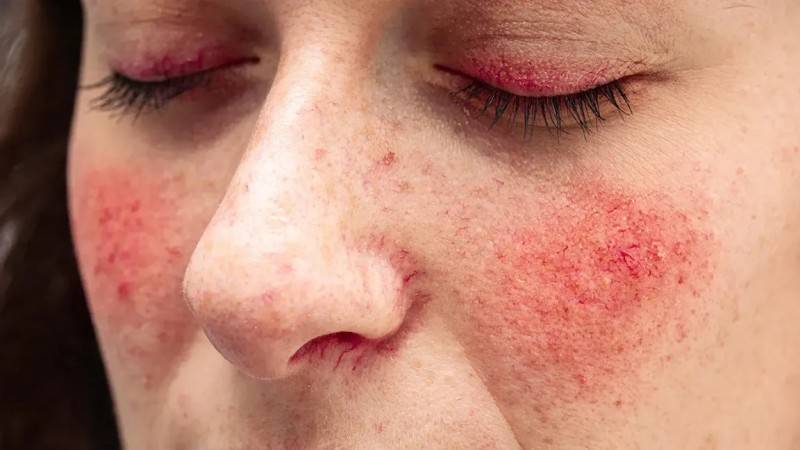 How to improve rosacea
