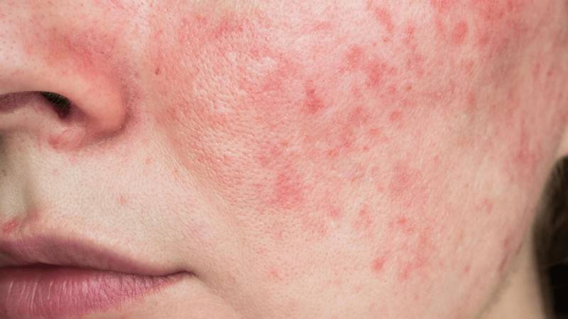 Effective ways to reduce redness on face