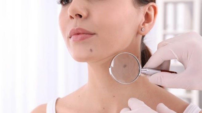 "Removing" or "keeping" moles: laser, surgery and natural removal, are they worth trying?