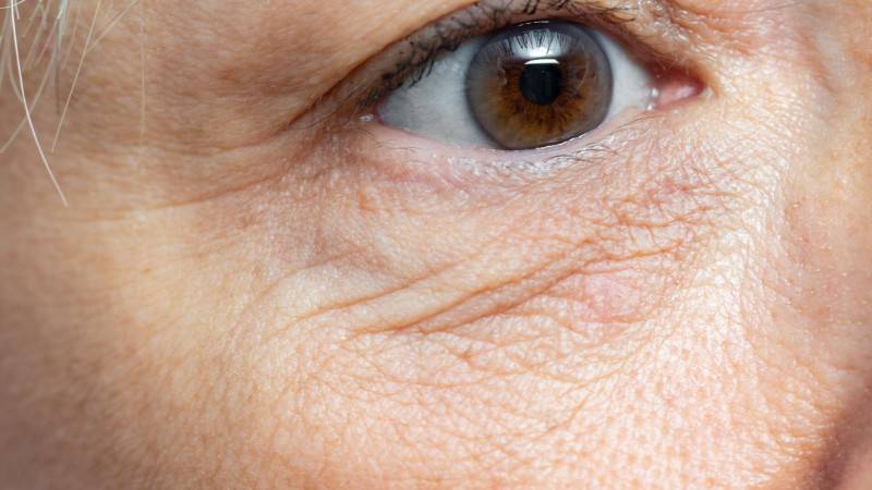 Causes and Prevention of Fine Lines Around the Eyes